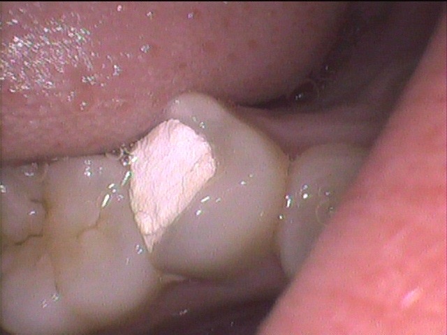 右下の奥歯を治療途中で放置していたら、痛みが出た症例　歯ぐきにプツッとできものができている症例　(根管治療)