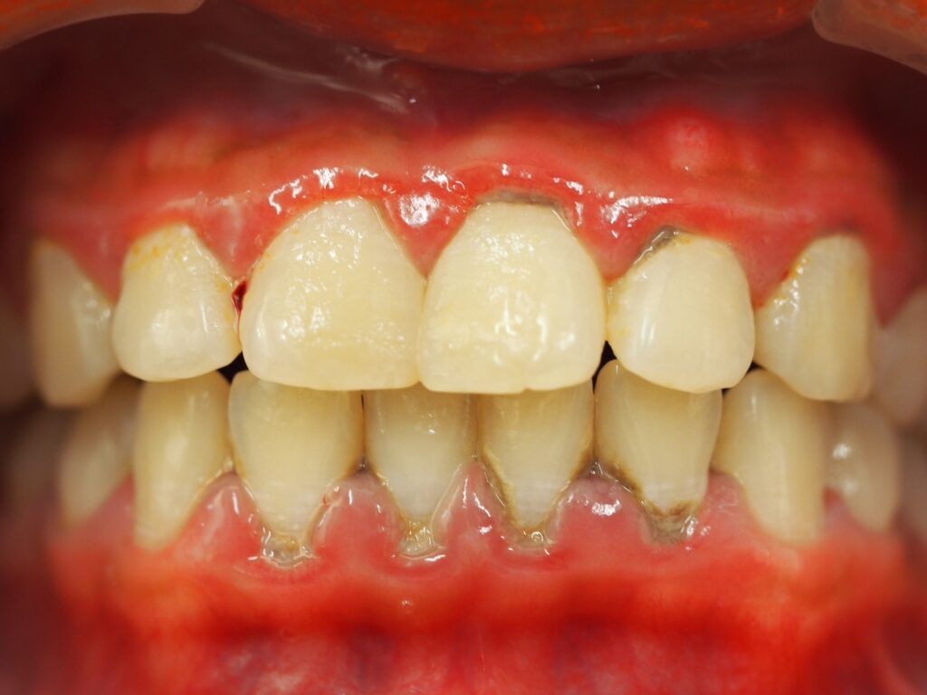 歯石除去ご希望で来院(予防治療/歯周病治療)