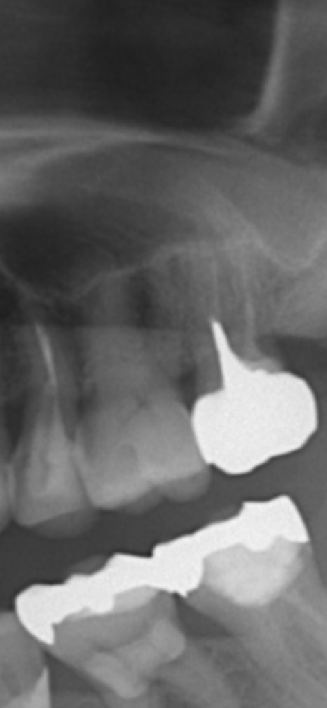 『CT撮影の重要性』左上の歯が噛むと浮いた感じがする。(根管治療)