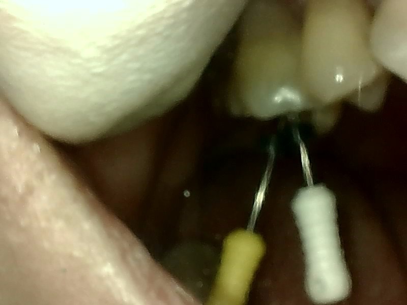臼歯部　セラミック修復(虫歯治療)