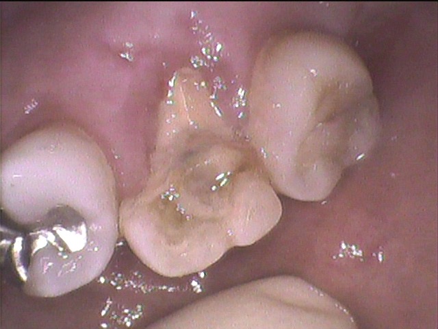 歯性上顎洞炎(副鼻腔炎)の治療　〜CT撮影の重要性〜