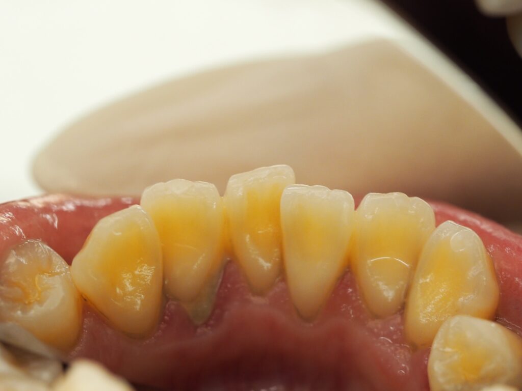 歯石除去　クリーニング症例