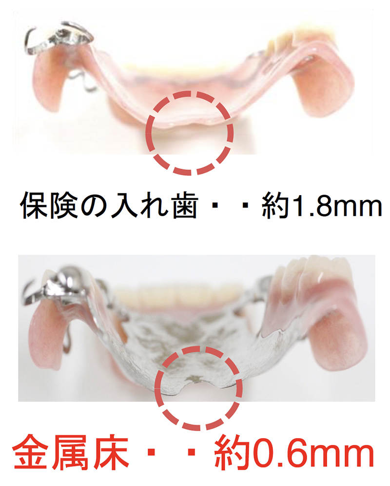 金属床義歯