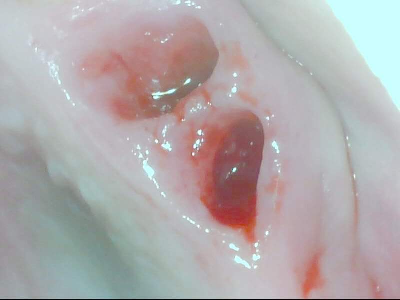 金属床義歯