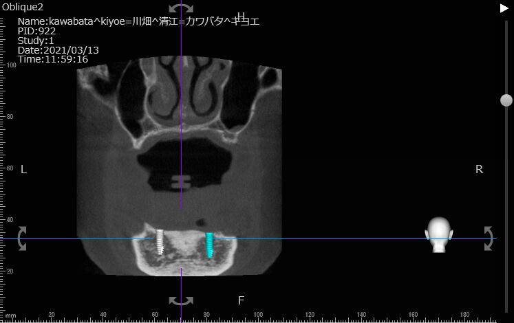 金属床義歯