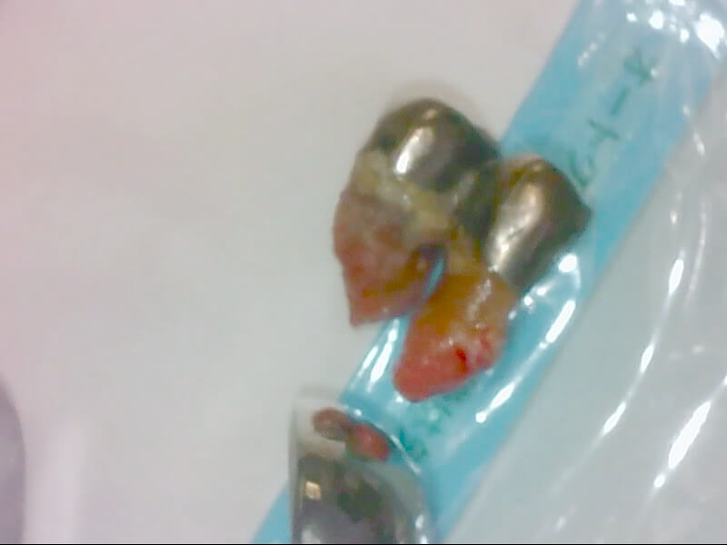 金属床義歯