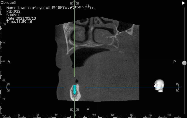 金属床義歯