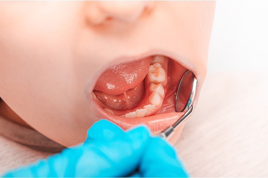 シーラント処置によるむし歯ゼロの取り組み